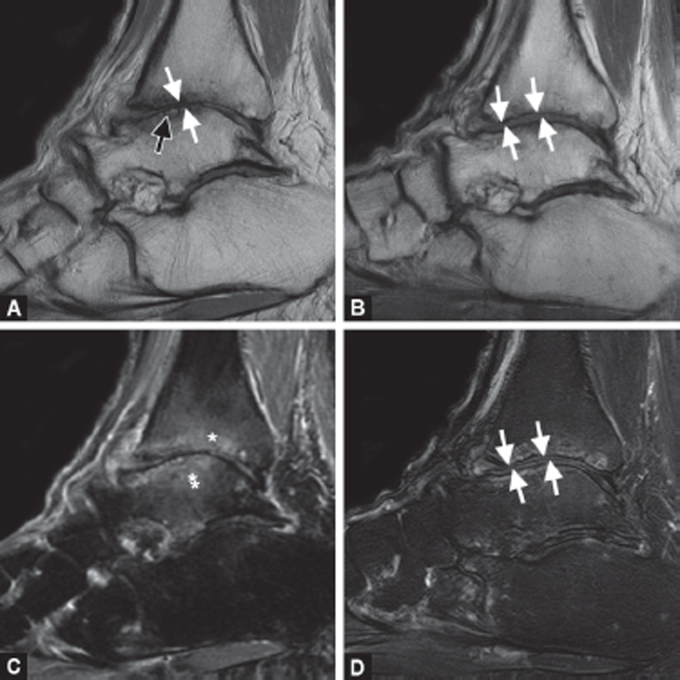 Short-term Results of Magnetic Resonance Imaging after Ankle Distraction Arthroplasty.