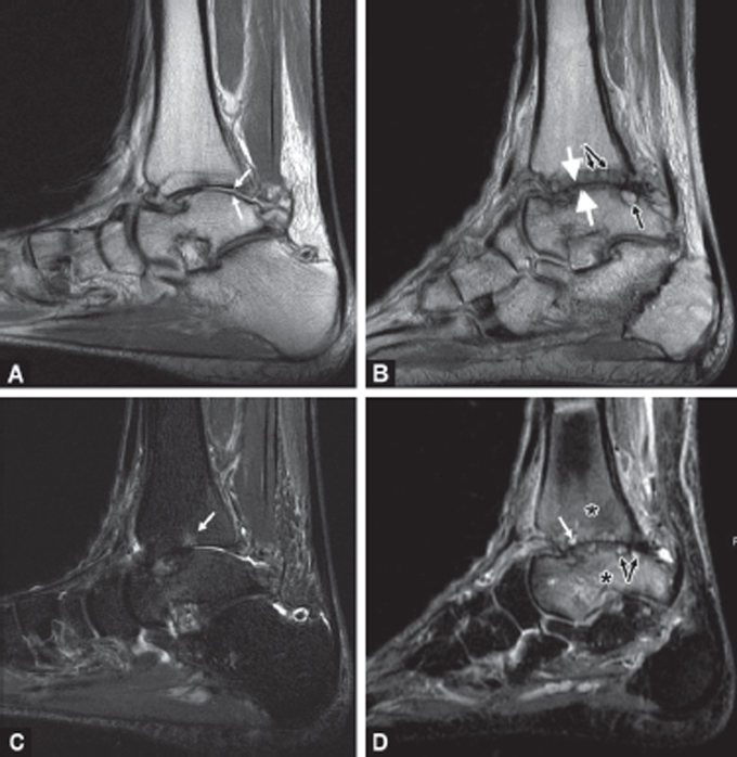 Short-term Results of Magnetic Resonance Imaging after Ankle Distraction Arthroplasty.