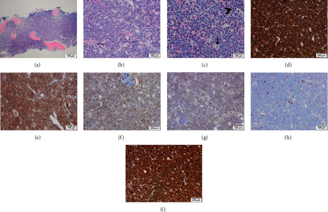 Bone Marrow Burkitt Lymphoma in a Child.