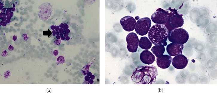 Bone Marrow Burkitt Lymphoma in a Child.