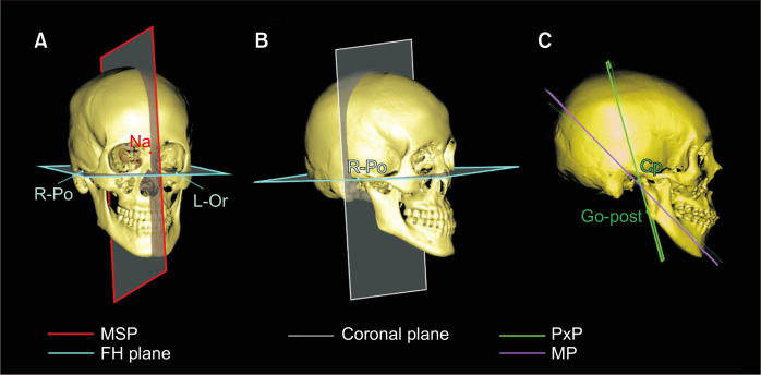 Positional changes in the mandibular proximal segment after intraoral vertical ramus osteotomy: Surgery-first approach versus conventional approach.