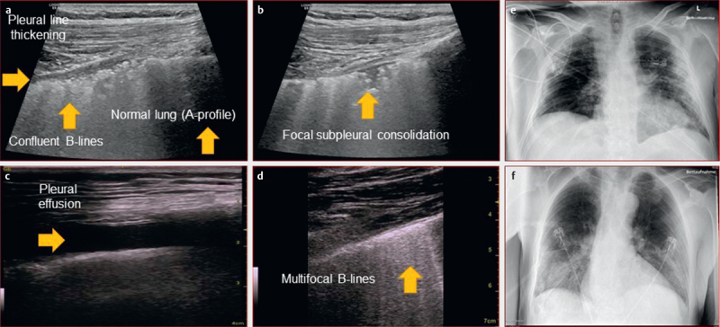 Comparison of Chest Ultrasound and Standard X-Ray Imaging in COVID-19 Patients.