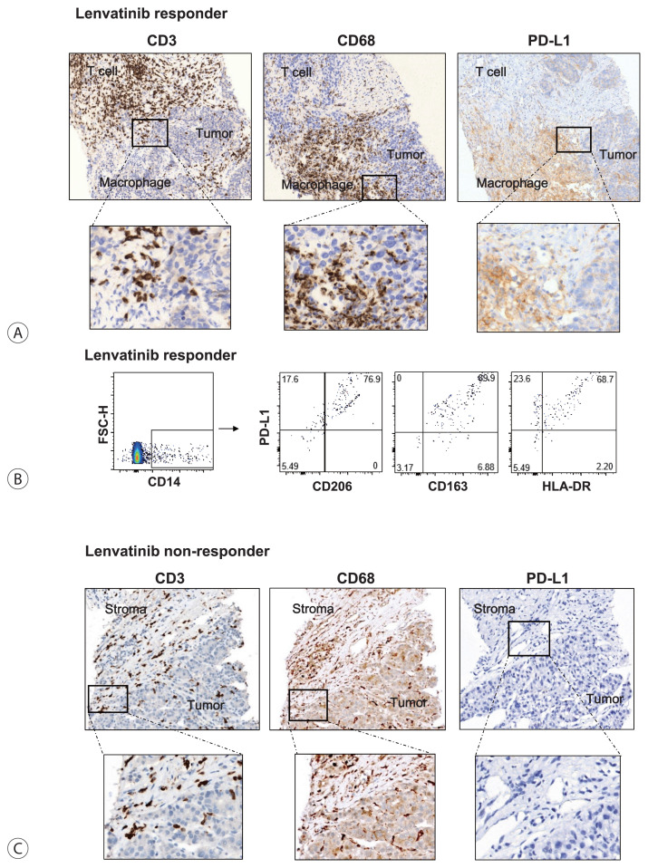 Infiltration of T Cells and Programmed Cell Death Ligand 1-expressing Macrophages as a Potential Predictor of Lenvatinib Response in Hepatocellular Carcinoma.