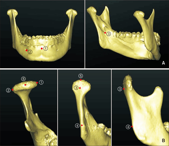 Positional changes in the mandibular proximal segment after intraoral vertical ramus osteotomy: Surgery-first approach versus conventional approach.