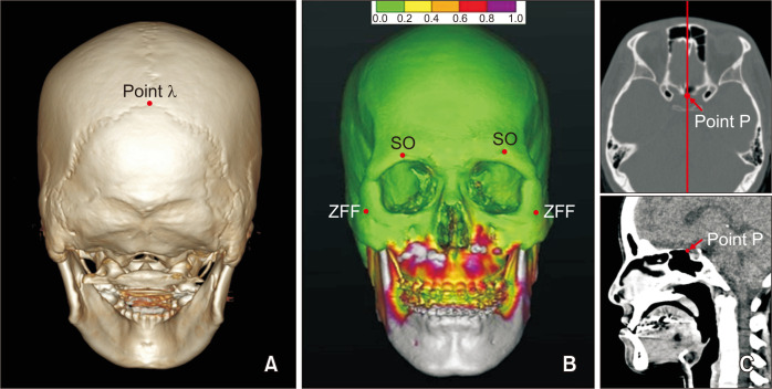 Positional changes in the mandibular proximal segment after intraoral vertical ramus osteotomy: Surgery-first approach versus conventional approach.