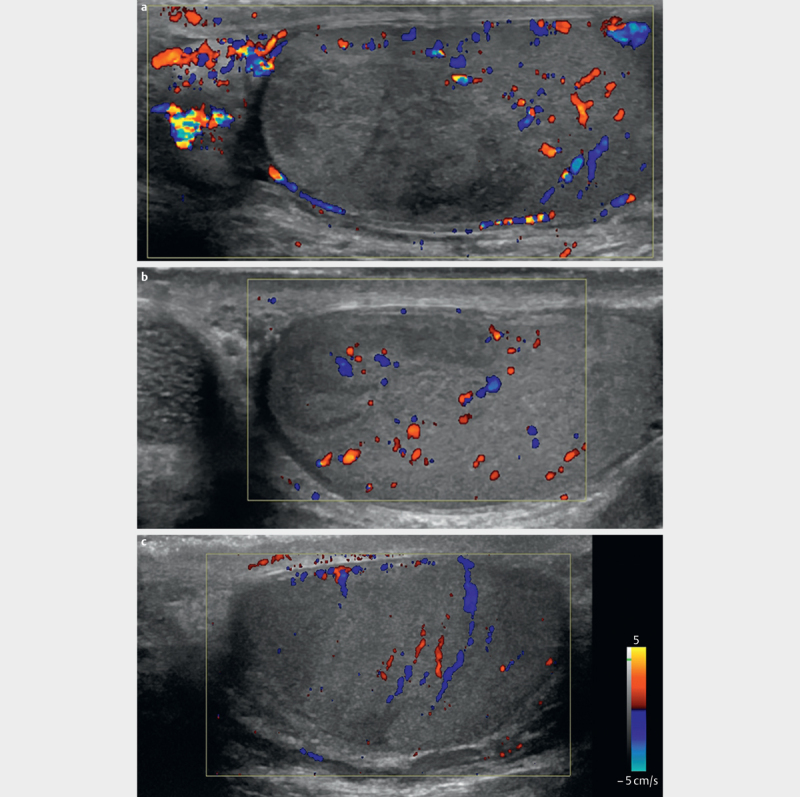 Segmental Testicular Infarction - Is Conservative Management Feasible?