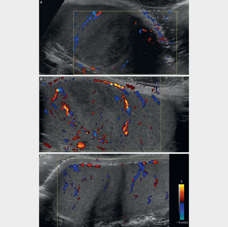 Segmental Testicular Infarction - Is Conservative Management Feasible?