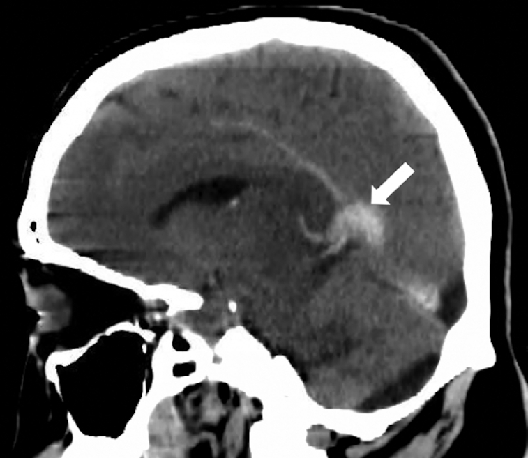 Outcomes and Spectrum of Major Neurovascular Events Among COVID-19 Patients: A 3-Center Experience.