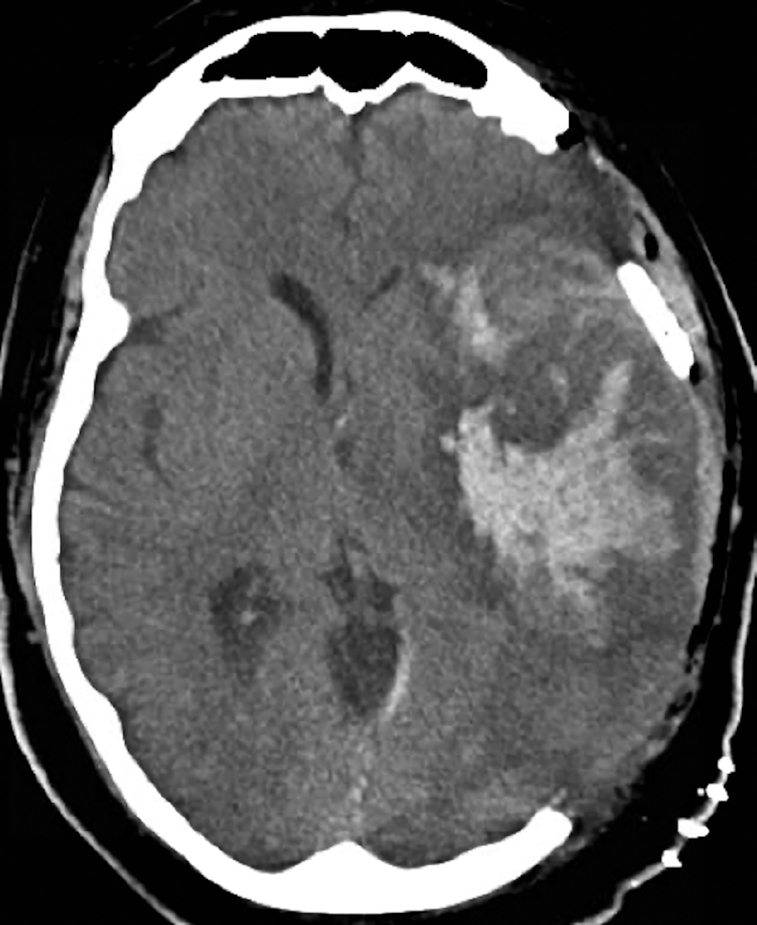 Outcomes and Spectrum of Major Neurovascular Events Among COVID-19 Patients: A 3-Center Experience.