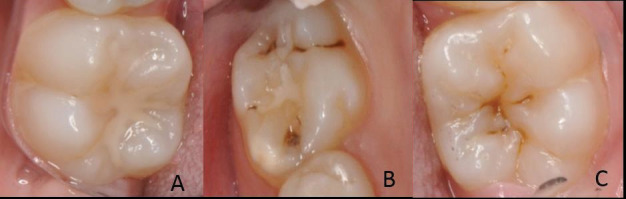 Clinical success rate of fissure sealants: one-year follow-up.