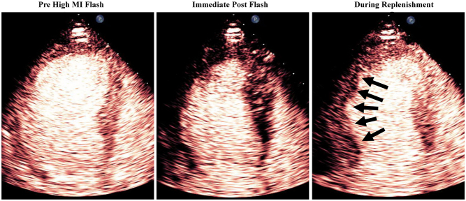 Prognostic value of resting myocardial contrast echocardiography: a meta-analysis.