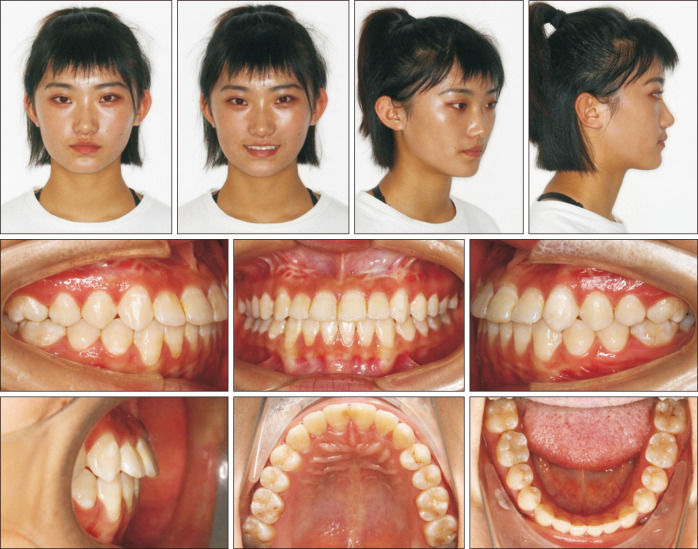 Maxillary protraction using customized mini-plates for anchorage in an adolescent girl with skeletal Class III malocclusion.