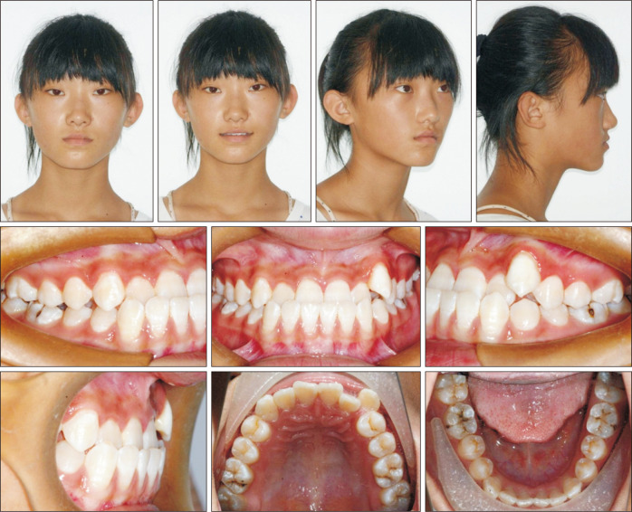 Maxillary protraction using customized mini-plates for anchorage in an adolescent girl with skeletal Class III malocclusion.