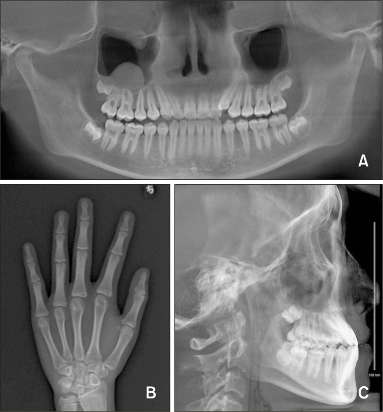 Maxillary protraction using customized mini-plates for anchorage in an adolescent girl with skeletal Class III malocclusion.