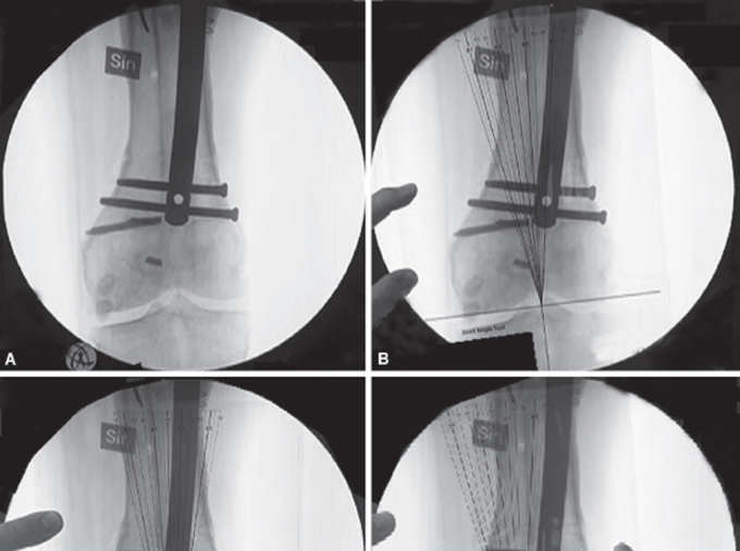 The Joint Angle Tool for Intraoperative Assessment of Coronal Alignment of the Lower Limb.