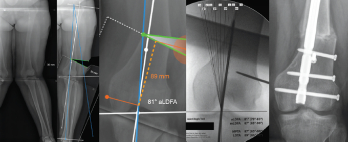 The Joint Angle Tool for Intraoperative Assessment of Coronal Alignment of the Lower Limb.