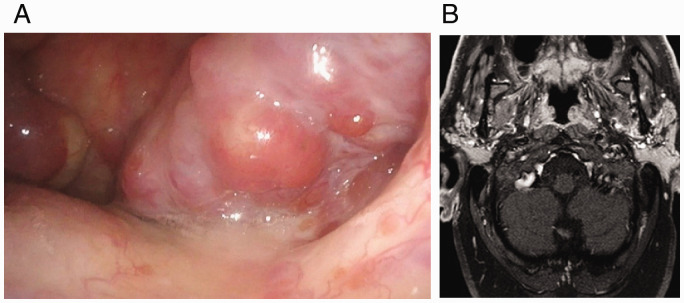 Oncocytic Cysts of the Nasopharynx: A Case Report.