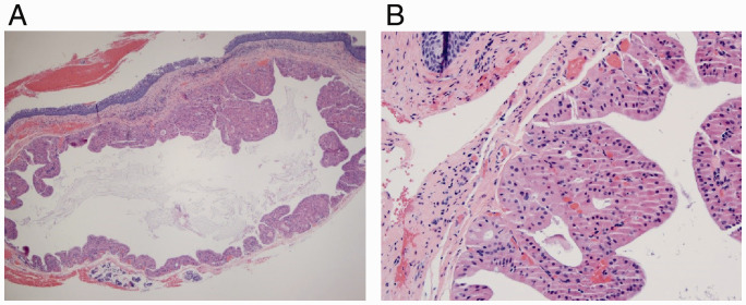 Oncocytic Cysts of the Nasopharynx: A Case Report.