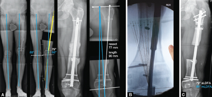 The Joint Angle Tool for Intraoperative Assessment of Coronal Alignment of the Lower Limb.