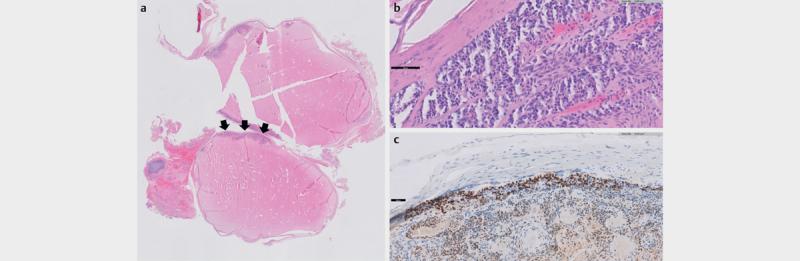 Unclear Cystic Lesion of the Thumb: A Rare Case of a Mainly Cystic Digital Papillary Adenocarcinoma.