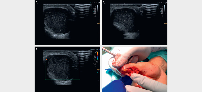 Unclear Cystic Lesion of the Thumb: A Rare Case of a Mainly Cystic Digital Papillary Adenocarcinoma.