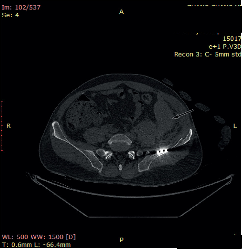 Rehabilitation Training Following Retroperitoneal Haemorrhage: A Case Report and Review of the Literature.