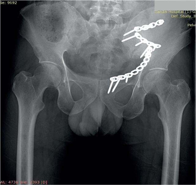 Rehabilitation Training Following Retroperitoneal Haemorrhage: A Case Report and Review of the Literature.