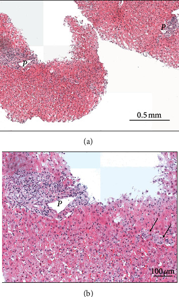 Disulfiram-Induced Acute Liver Injury.