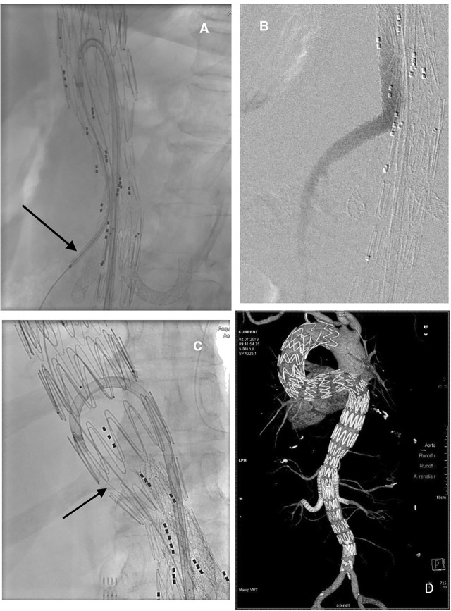 Improved stability of steerable sheath access by femoro-femoral crossover wire in branched stent graft repair of complex thoraco-abdominal aortic aneurysms.