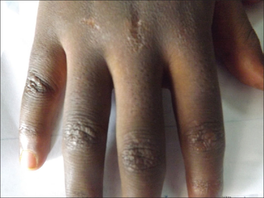 Juvenile Dermatomyositis in an 11 Year Old Nigerian-Boy: A Case Report and Review of Literature.