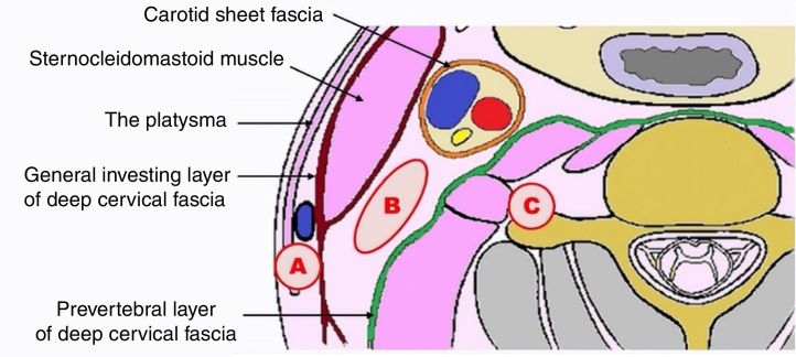 Bloqueio do plexo cervical como técnica anestésica alternativa para tireoplastia tipo I: relato de caso