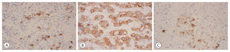 Rare Clinical and Radiologic Case of Cholangiocarcinoma Mimicking Pyogenic Abscess, Hepatic Echinococcal Cysts, and Metastases.