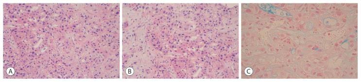 Rare Clinical and Radiologic Case of Cholangiocarcinoma Mimicking Pyogenic Abscess, Hepatic Echinococcal Cysts, and Metastases.