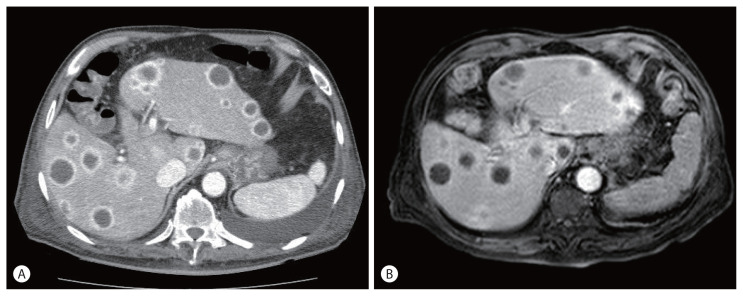 Rare Clinical and Radiologic Case of Cholangiocarcinoma Mimicking Pyogenic Abscess, Hepatic Echinococcal Cysts, and Metastases.