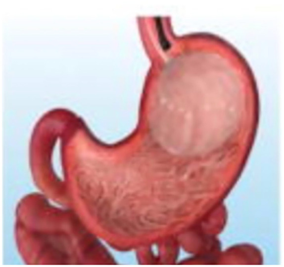 Overview of bariatric and metabolic endoscopy interventions.