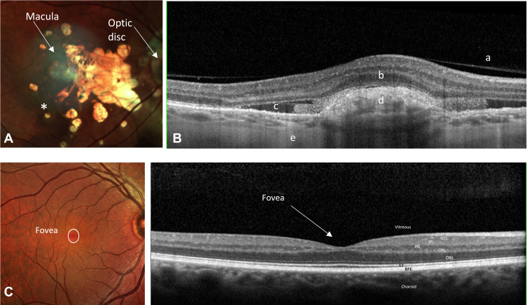 Gene, Cell and Antibody-Based Therapies for the Treatment of Age-Related Macular Degeneration.