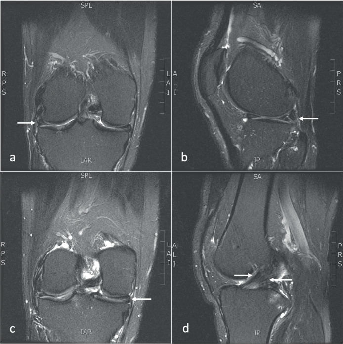 Hooverball: Case Study, Literature Review and Clinical Recommendations.