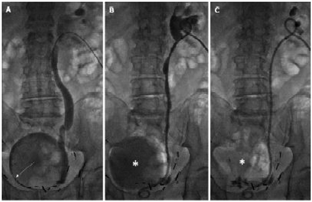 Estimation of successful capping with complete aspiration of bladder <i>via</i> nephroureterostomy tube.