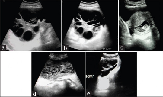 Spontaneous Ovarian Hyperstimulation Syndrome: A Report of Two Cases from Different Pathogenesis.