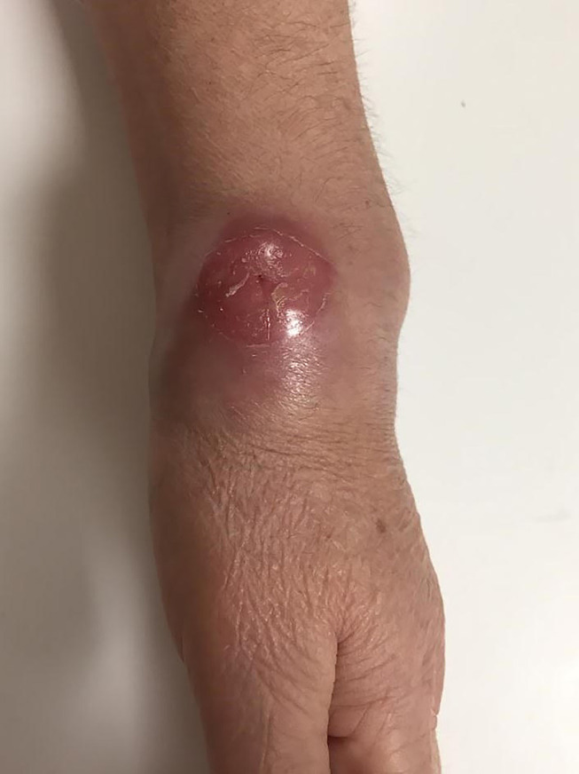 Tuberculosis Arthritis in the Wrist While Using Rituximab for Rheumatoid Arthritis Treatment.