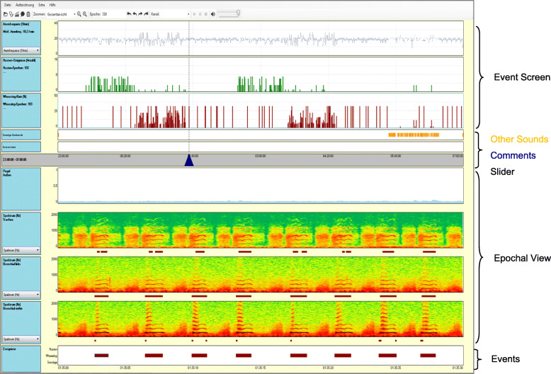 Disease control in patients with asthma and respiratory symptoms (wheezing, cough) during sleep.