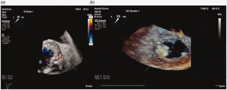 Paravalvular leak closure with real time transesophageal echocardiography and fluoroscopy fusion.