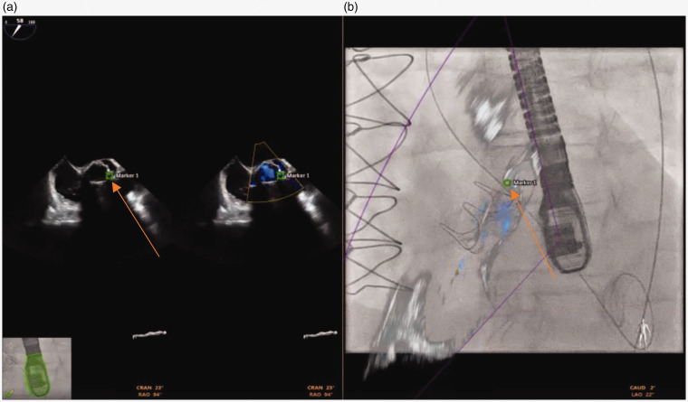 Paravalvular leak closure with real time transesophageal echocardiography and fluoroscopy fusion.