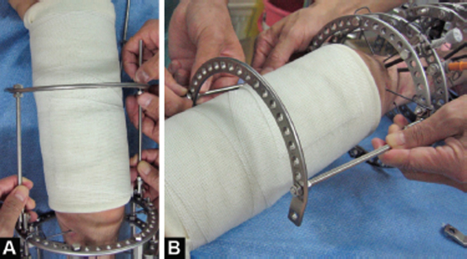 Hybrid Fixation for Paediatric Femoral Supracondylar Fracture during Circular External Fixation of the Lower Limb.