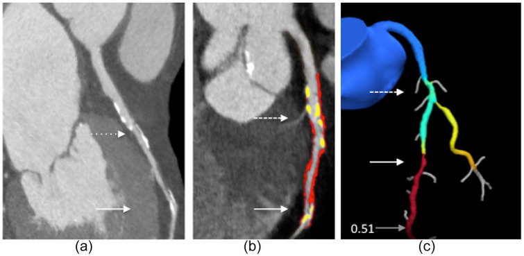 Coronary flow impairment in asymptomatic patients with early stage type-2 diabetes: Detection by FFR<sub>CT</sub>.