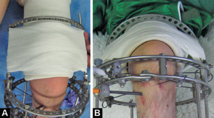 Hybrid Fixation for Paediatric Femoral Supracondylar Fracture during Circular External Fixation of the Lower Limb.