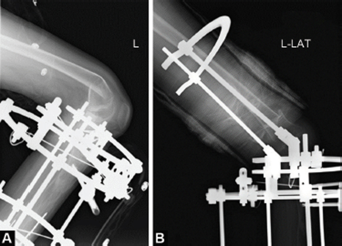 Hybrid Fixation for Paediatric Femoral Supracondylar Fracture during Circular External Fixation of the Lower Limb.