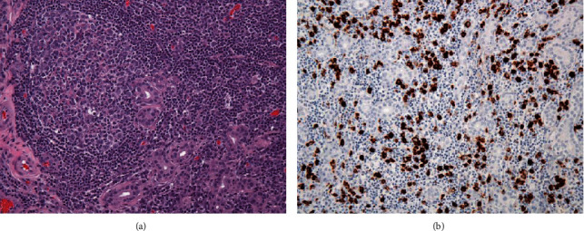 Image-Guided Intensity-Modulated Radiation Therapy for IgG4-Related Ophthalmic Disease.