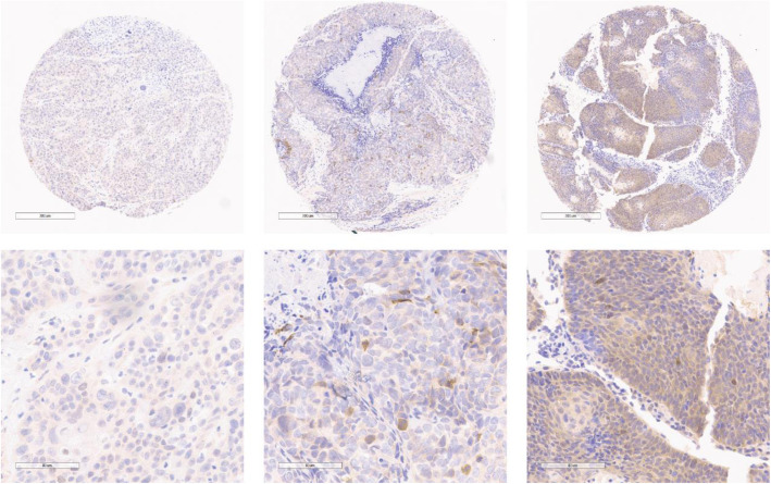 Determining the molecular landscape and impact on prognosis in HPV-associated head and neck cancer.