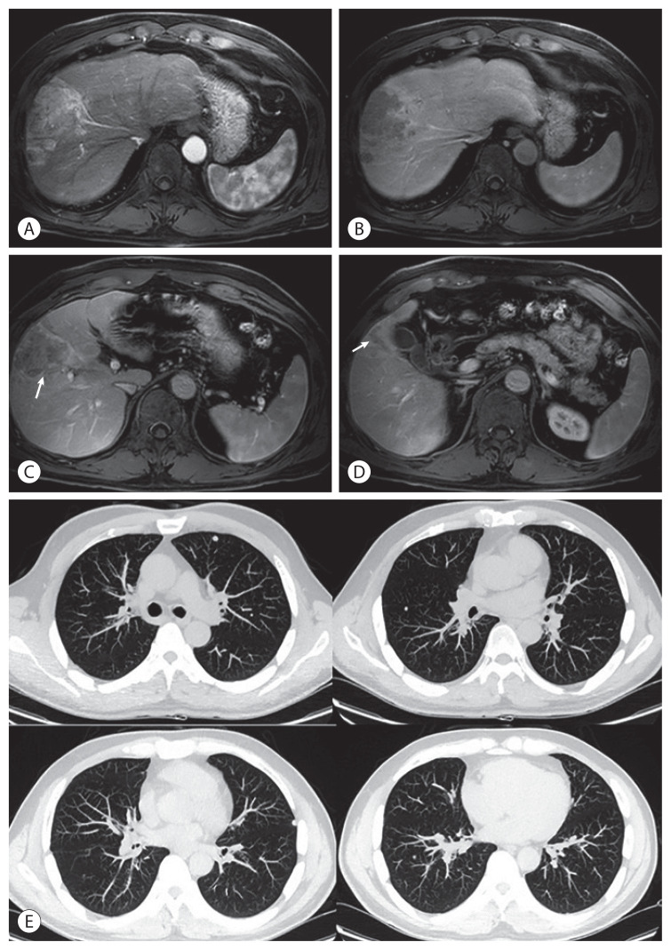 Advanced Stage Hepatocellular Carcinoma Successfully Treated with Transarterial Radioembolization and Multi-tyrosine Kinase Inhibitor Therapy.